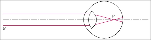 Schéma optique montrant la focalisation des rayons lumineux avant la rétine, caractéristique de la myopie. L’image se forme en avant du point de netteté idéal.