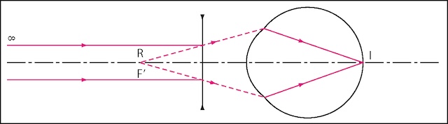 Schéma illustrant comment une lentille divergente corrige la myopie en projetant les rayons lumineux directement sur la rétine.