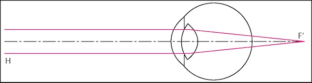 Représentation optique du foyer situé en arrière de la rétine chez un œil hypermétrope. Illustration du défaut de convergence visuelle.