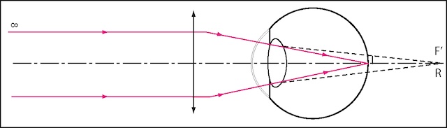 Lentille convexe recentrant les rayons parallèles pour corriger l’hypermétropie et permettre une mise au point directe sur la rétine.