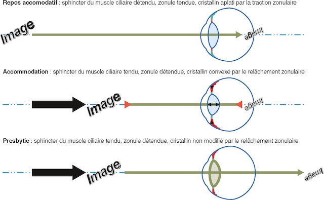 Comparaison visuelle du cristallin en vision lointaine, en accommodation et en presbytie, selon l’état du muscle ciliaire et des zonules.