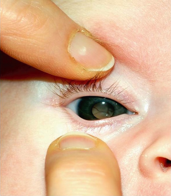 Photographie pédiatrique montrant une leucocorie à droite, évocatrice d’un rétinoblastome, signe clinique majeur chez l’enfant.