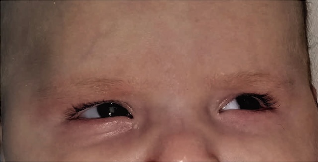 Présence d’un reflet blanc anormal à droite chez un nourrisson, évoquant une cataracte congénitale nécessitant une intervention rapide.