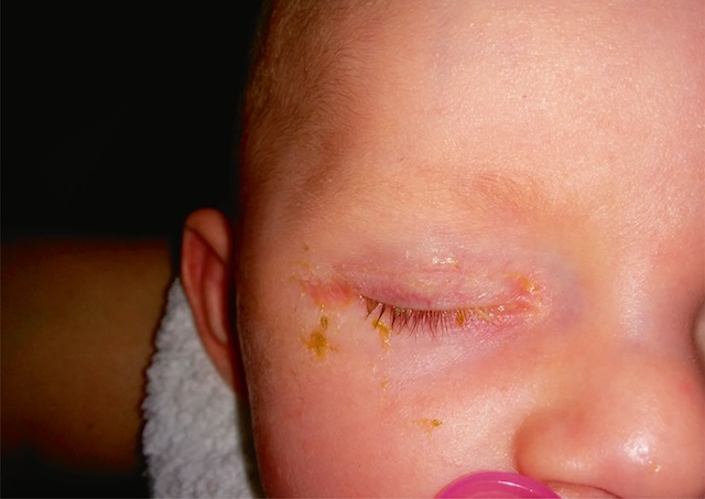 Écoulement jaune collé aux cils d’un nourrisson, suggérant une conjonctivite infectieuse. Inflammation visible, paupière fermée par gêne locale.