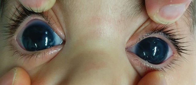 Photographie clinique d’un glaucome congénital bilatéral avec dilatation cornéenne et bombement oculaire chez un jeune enfant.
