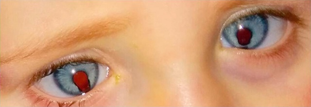 Photographie montrant un colobome irien bilatéral, avec pupilles déformées en forme de larme. Aspect typique visible dans les deux yeux d’un enfant.