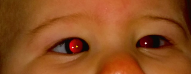 Reflet rouge bilatéral visible et centré sur les deux pupilles chez un nourrisson, traduisant une transparence normale des milieux oculaires.