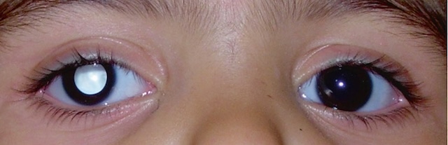 Leucocorie gauche chez un enfant, évoquant un rétinoblastome, contraste net avec le reflet pupillaire noir physiologique à droite.