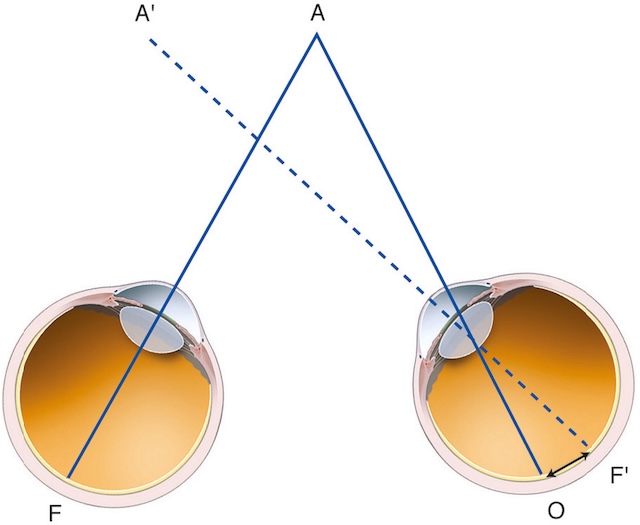 Schéma montrant une déviation unilatérale de l’axe visuel droit, traduisant un défaut d’alignement binoculaire.