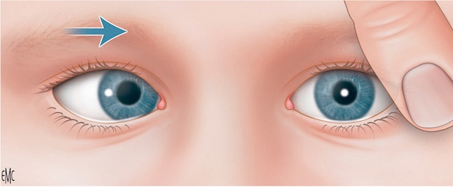 Un reflet rouge normal à gauche et un œil droit qui dévie vers le nez, évoquant un strabisme convergent chez un nourrisson.