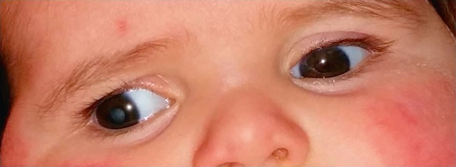 Photographie pédiatrique montrant une leucocorie droite avec strabisme divergent révélateur d’une cataracte congénitale.