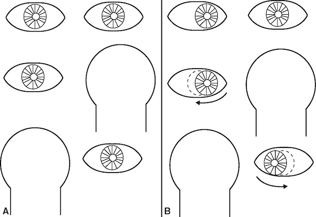 Illustration séquentielle d’un test à l’écran, montrant les mouvements oculaires lors d’une occlusion alternée. Méthode utilisée pour détecter un strabisme latent.