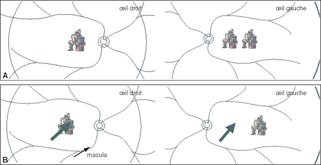 Comparaison visuelle entre diplopie monoculaire et binoculaire, soulignant leur origine respective et le rôle clé du test œil par œil.