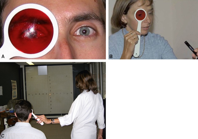 Examen binoculaire avec filtre rouge permettant de repérer une diplopie ou une anomalie oculomotrice dans un contexte clinique structuré.