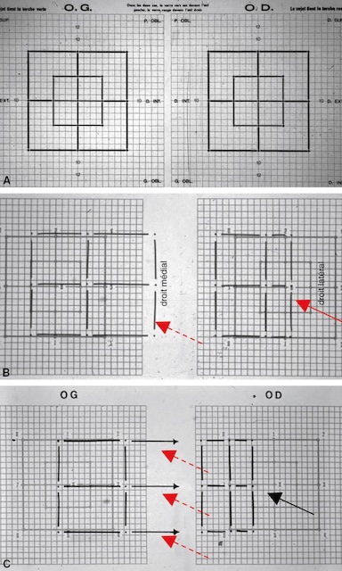 Trois planches du test de Hess-Lancaster montrant une vision binoculaire normale, une ésotropie, puis un déficit moteur de l’œil droit. Évaluation visuelle graphique de la coordination oculaire.