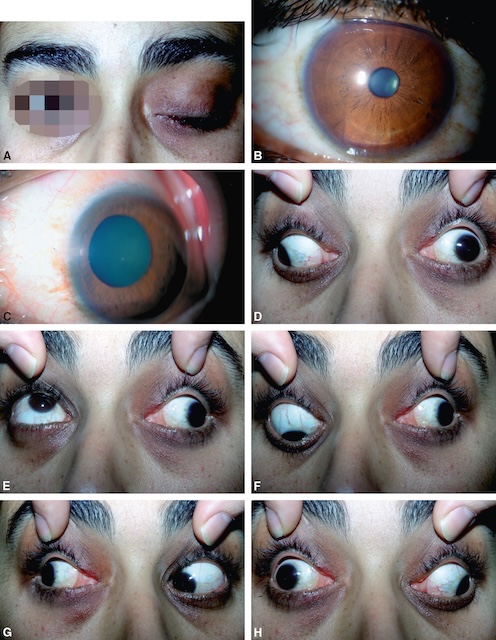 Série clinique montrant une paralysie complète du nerf III gauche avec ptôse, mydriase fixe et paralysie oculomotrice totale.