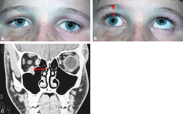 Limitation de l’élévation de l’œil droit, associée à une fracture du plancher orbitaire visible au scanner avec hernie dans le sinus maxillaire.
