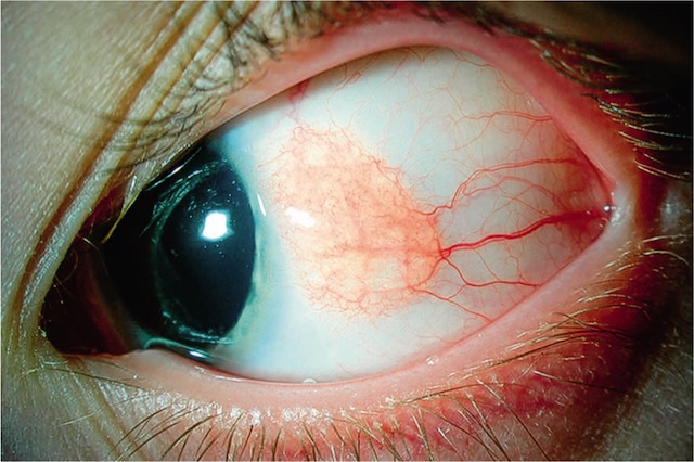 Zone congestive bien circonscrite évoquant un nævus achrome conjonctival, bénin, sans signe de complication ni d’extension cornéenne.