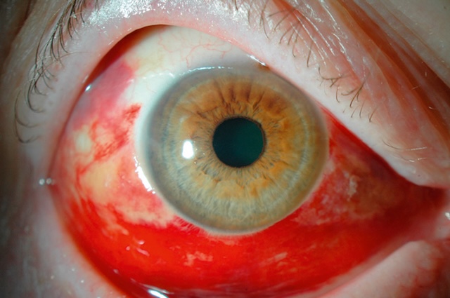Hémorragie sous-conjonctivale étendue mais isolée, sans signes associés ni atteinte fonctionnelle oculaire. Aspect marquant, évolution bénigne.