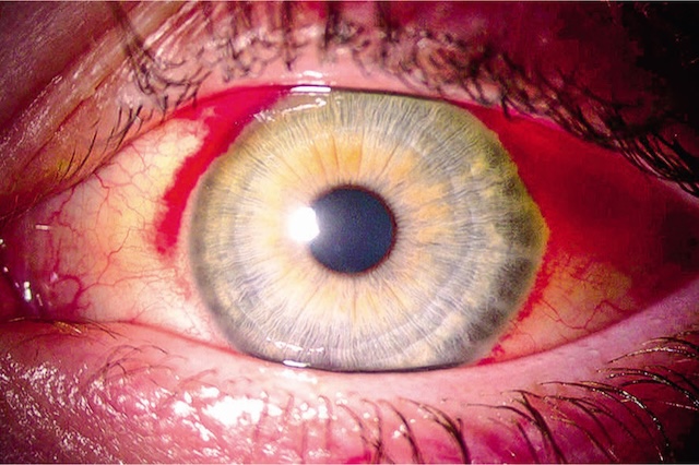 Épanchement de sang net sous la conjonctive, sans atteinte de la cornée ni symptôme associé, évocateur d’une hémorragie sous-conjonctivale isolée.