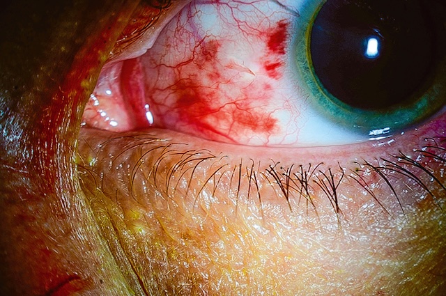 Œil rouge post-traumatique avec suspicion de lésion pénétrante. Signe clinique d’un corps étranger intraoculaire postérieur.