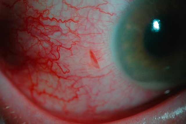 Traumatisme perforant avec inflammation sévère. Plaie oculaire compliquée d’hypopion endophtalmique.