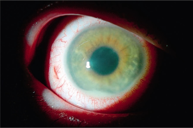 Œil rouge avec opacité centrale évoquant un corps étranger intraoculaire compliqué d’endophtalmie, nécessitant une prise en charge immédiate.