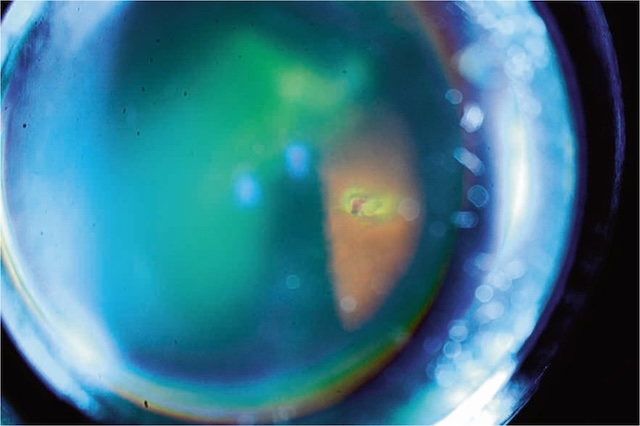 Fragment intraoculaire logé dans la rétine, visible en imagerie centrée sur le fond d’œil, associé à un traumatisme pénétrant postérieur.