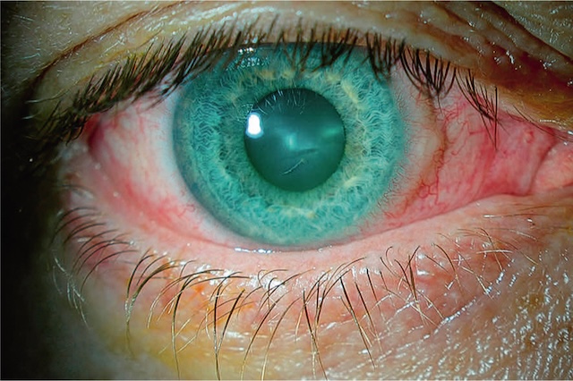 Œil traumatisé avec plaie cornéenne cicatrisée et cataracte traumatique centrale bien visible.