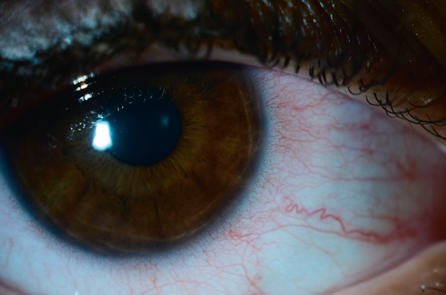 Cercle périkératique bien marqué, typique d’une inflammation oculaire profonde, visible en périphérie cornéenne sur cet examen clinique.