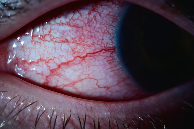 Corps étranger rétinien postérieur visible en fond d’œil, encastré dans la rétine centrale, indiquant un traumatisme intraoculaire pénétrant à haute vélocité.