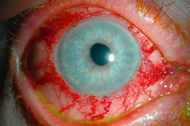 Œil bleuté avec hyperémie conjonctivale sévère en motif de tête de méduse, fortement évocatrice d’une fistule carotido-caverneuse.