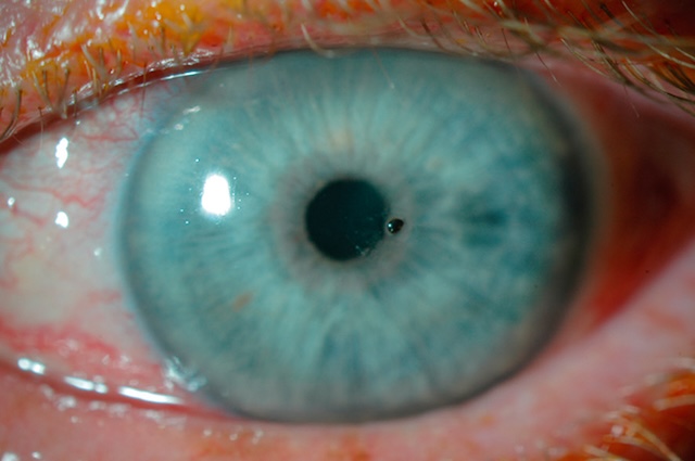 Présence d’un fragment métallique superficiel centré sur la cornée, bien visible en macrophotographie, nécessitant un retrait rapide pour prévenir toute complication.