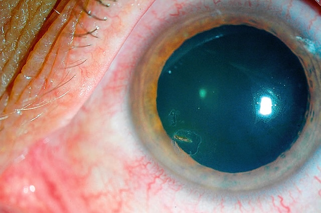 Présence d’un éclat métallique logé dans la cornée, avec inflammation périphérique, évoquant une blessure traumatique localisée.