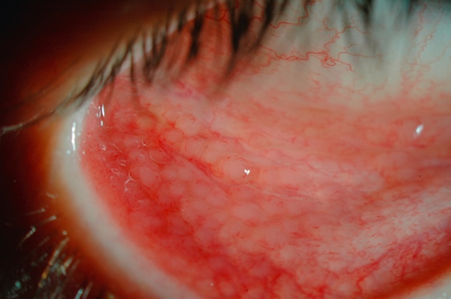 Aspect folliculaire marqué sur la conjonctive inférieure, typique d'une conjonctivite d’origine virale ou médicamenteuse.