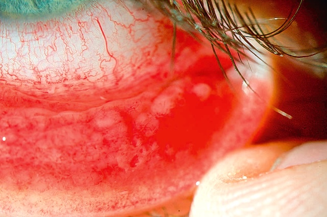 Conjonctive inférieure rouge, follicules visibles et surface irrégulière : tableau typique d'une conjonctivite infectieuse.