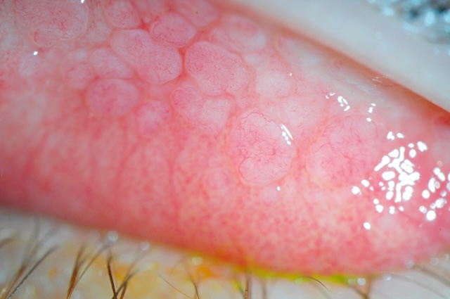 Papilles proéminentes à centre vasculaire sur la conjonctive supérieure, traduisant une inflammation chronique d’origine allergique ou mécanique.