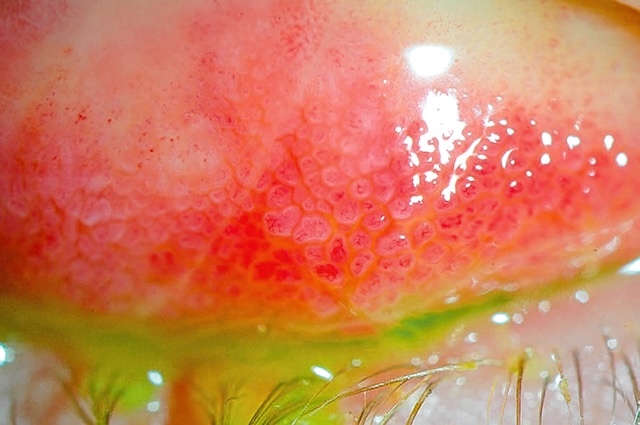 Aspect typique de papilles en mosaïque sur la conjonctive tarsale supérieure, associé à une allergie oculaire avec sécrétion muqueuse visible.