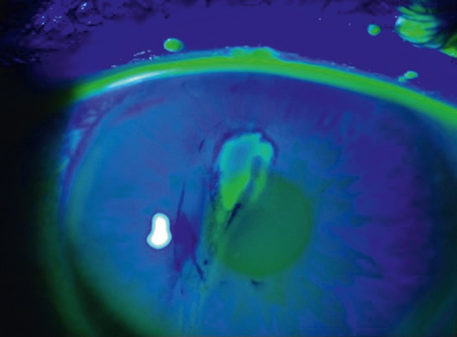 Ulcération cornéenne verticale captant la fluorescéine, liée à un traumatisme par allumette, typique d’une atteinte épithéliale directe.