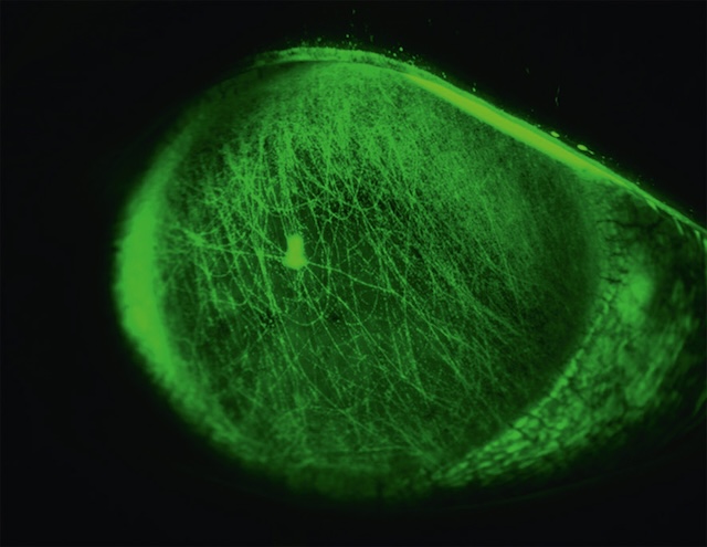 Stries verticales cornéennes fluorescentes dues à un corps étranger sous la paupière supérieure, visualisées en lumière bleue.