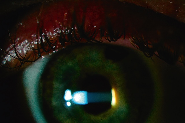 Effet de brouillard lumineux dans l’œil illustrant un Tyndall protéique, marqueur d’uvéite antérieure chronique active.