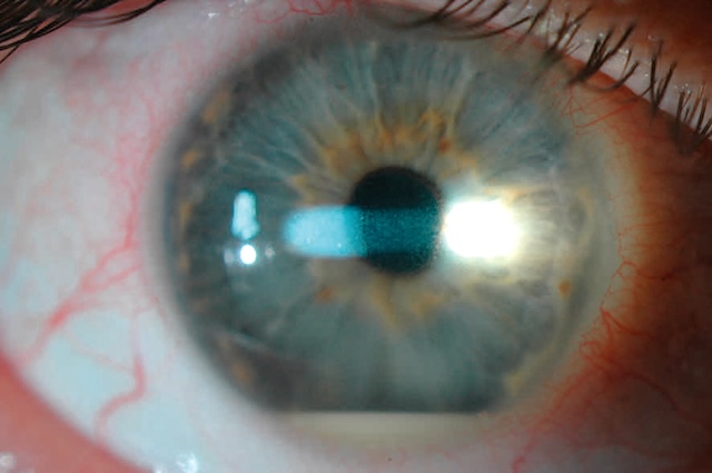 Présence d’un effet Tyndall et d’un hypopion, témoignant d’une inflammation aiguë de la chambre antérieure lors d’une uvéite antérieure.