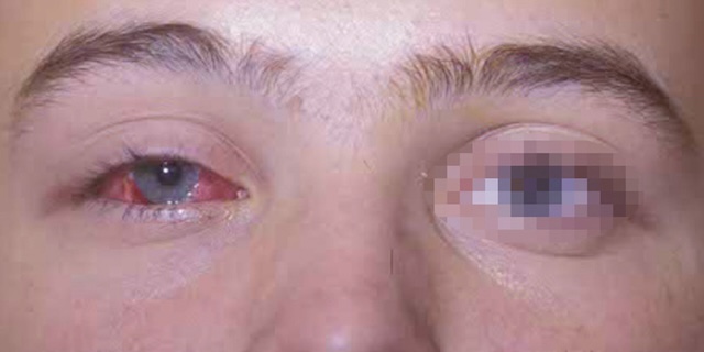 Œil droit rouge, conjonctivite isolée sans atteinte de l’œil gauche, aspect bénin mais bien franc.