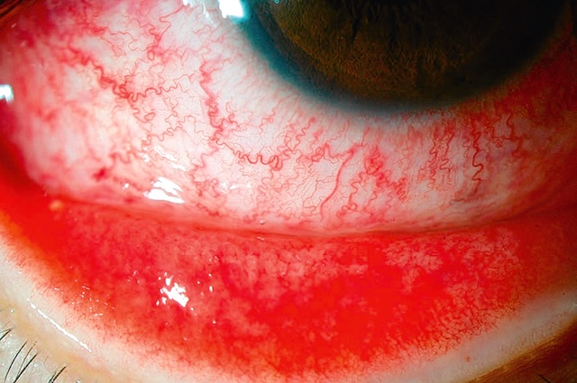Œil inflammé avec rougeur conjonctivale diffuse, vascularisation dense évoquant une conjonctivite virale active.
