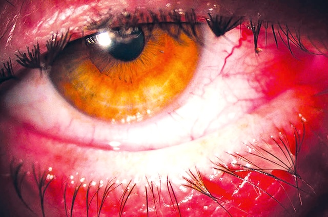 Œil rouge, vaisseaux dilatés et paupières irritées illustrant une conjonctivite aiguë en phase inflammatoire visible.