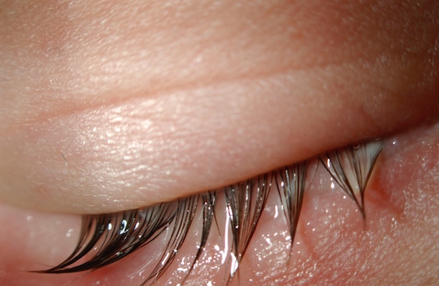 Cils collés par des sécrétions purulentes, aspect typique d’une conjonctivite bactérienne à un stade modéré, observé en vue clinique rapprochée.