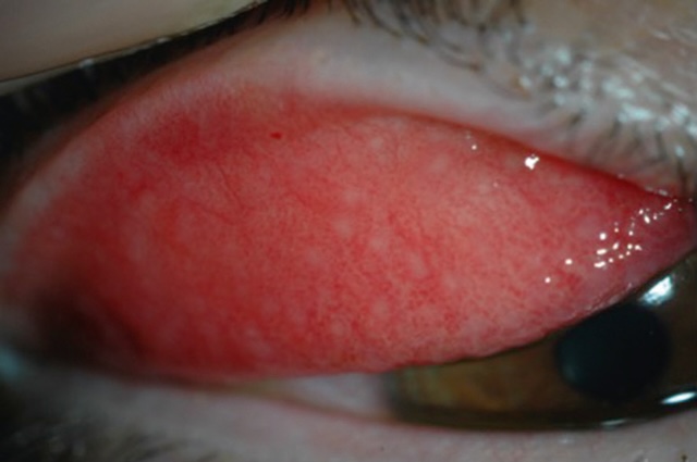 Vue claire d’une paupière enflammée où des follicules trahissent une infection à Chlamydia, souvent sournoise mais bien visible ici.