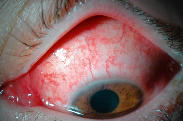 Œil très rouge avec hémorragie conjonctivale localisée, évocateur d’une conjonctivite virale adénovirale sévère.