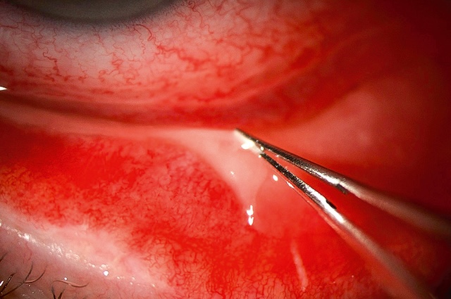 Retrait précis d’une fausse membrane conjonctivale dans un œil enflammé par conjonctivite adénovirale sévère.
