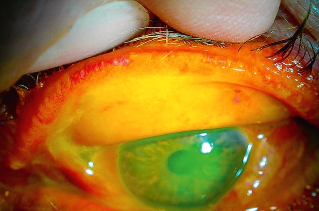 Retrait délicat d’une fausse membrane sur conjonctive enflammée lors d’une conjonctivite virale.